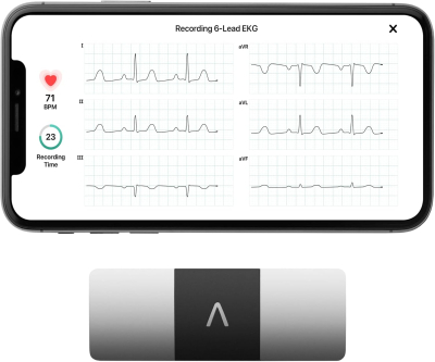 Personal EKG Monitor